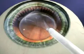 EVO+ VISIAN ICL implantierbare Kontaktlinse EVO+ VISIAN ICL implantierbare Kontaktlinse, Schema wie die Linse ins Auge implantiert wird.