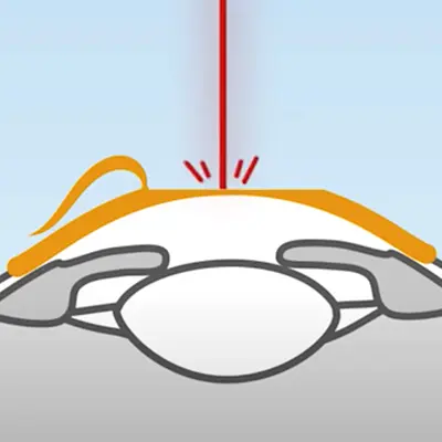 Beim Augenlaser Verfahren LASIK wird ein kleiner Hornhautschnitt gesetzt, der sogenannte "Flap". Dieser muss angehoben werden, damit der Laser in das Gewebe eindringen kann.