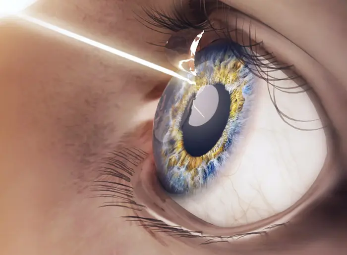 Symbolbild einer LASIK-Hornhautkorrektur: Grafische Nahaufnahme eines Auges mit blau-gelber Iris, bei dem ein Laserstrahl den Hornhaut-Flap anhebt – nicht eine echte Aufnahme einer Operation.
