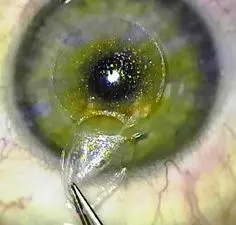 Relex Smile Augenlasern - Entfernung des Lentikels aus der Hornhaut Auge bei einer Augenoperation mit Relex Smile in Nahaufnahme. Gezeigt wird, wie mit einer Pinzette das Lentikel aus der Hornhaut entfernt wird.